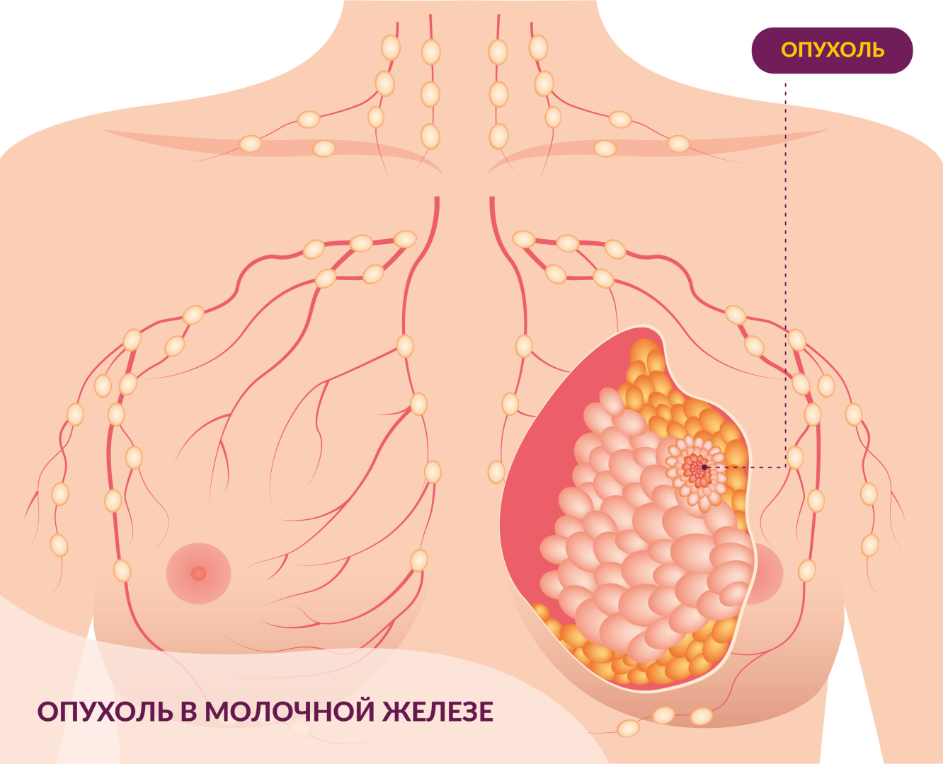 опухоль на груди у женщин фото 8